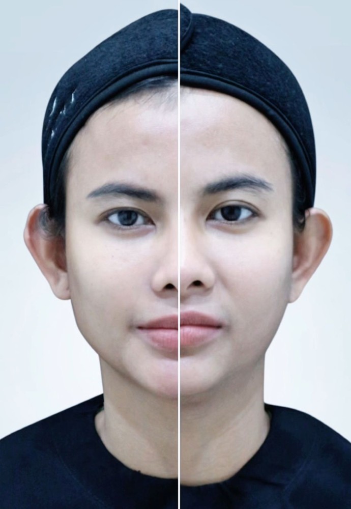 Miracle Clinic Jawab Keresahan Kulit Kendur Dengan Luncurkan Miracle Ultherapy Trilogy Prime Lift Tanpa Bedah